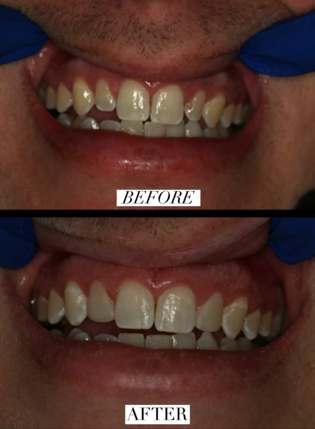 Before-and-after cosmetic dentistry result at iDental Dilworth in Charlotte, NC