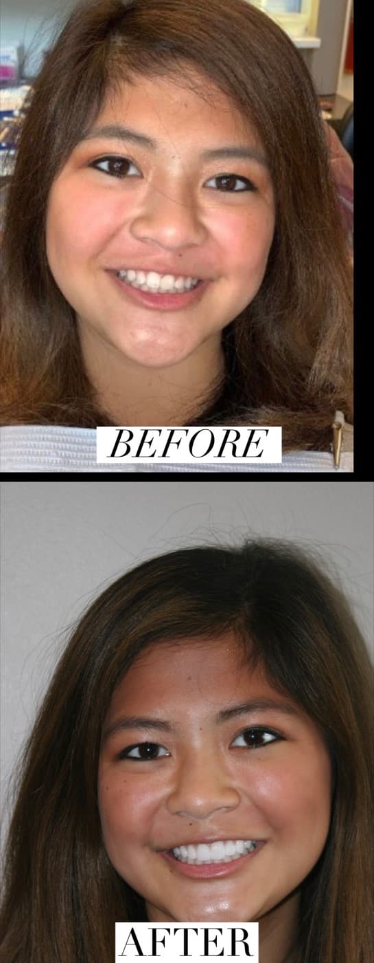 Before-and-after dental veneers result at iDental Dilworth in Charlotte, NC