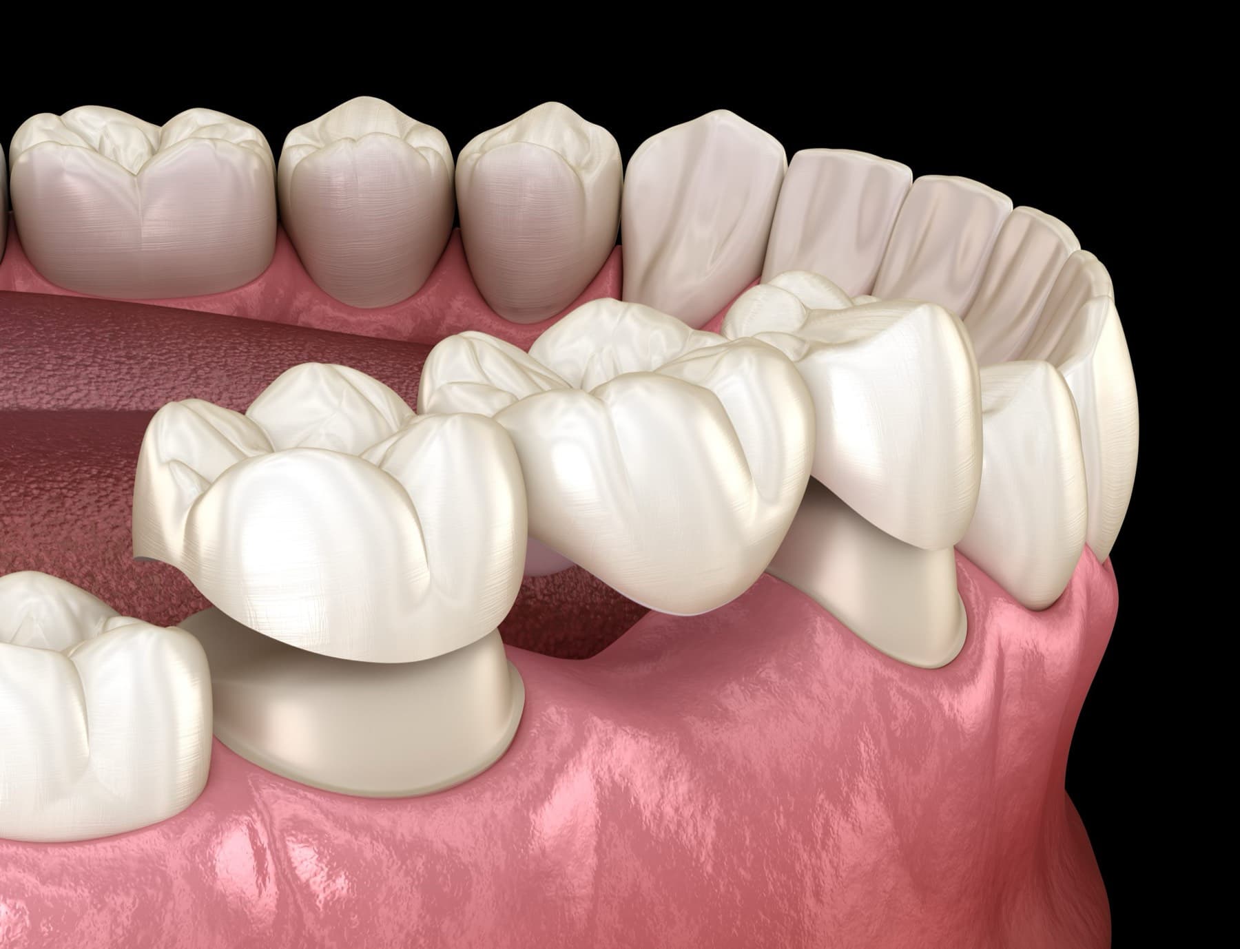 Dental Bridges at iDental Dilworth in Charlotte, NC